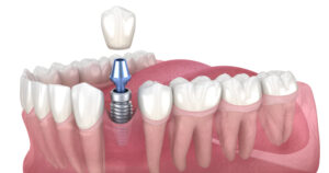 A 3D graphic of a dental implant